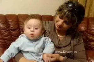 синдром дауна